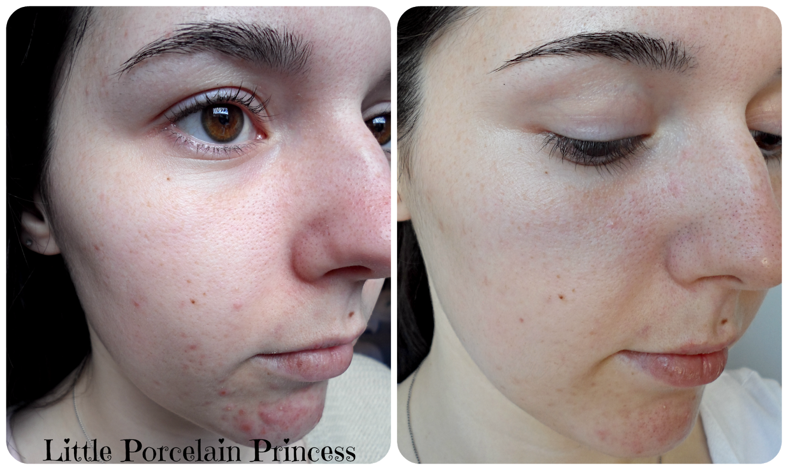 doxycycline acne buy doxycycline acne buy